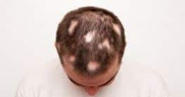 Diffuser Haarausfall