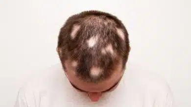 Diffuser Haarausfall