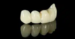 Keramik für Zahnimplantate