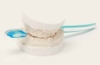 Kontraindikationen: Für wen sind Zahnimplantate nicht geeignet?